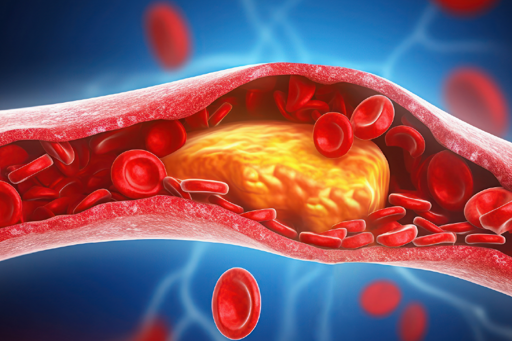 Understanding the Early Warning Signs of High Cholesterol: What You Need to Know