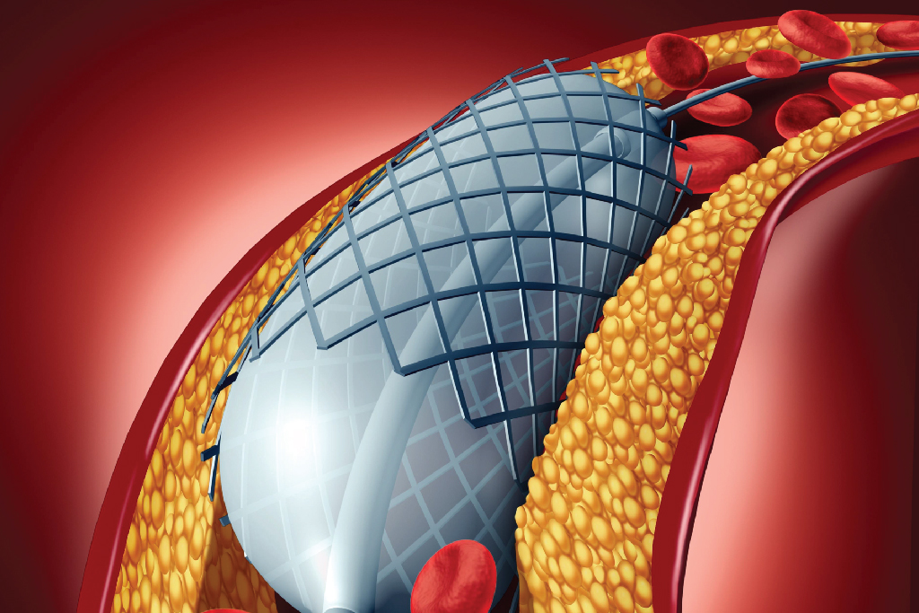 Role of Angiography in Diagnosing Heart Disease