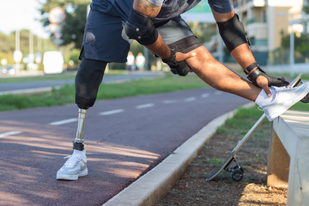 Redefining Life Through Amputation Rehabilitation