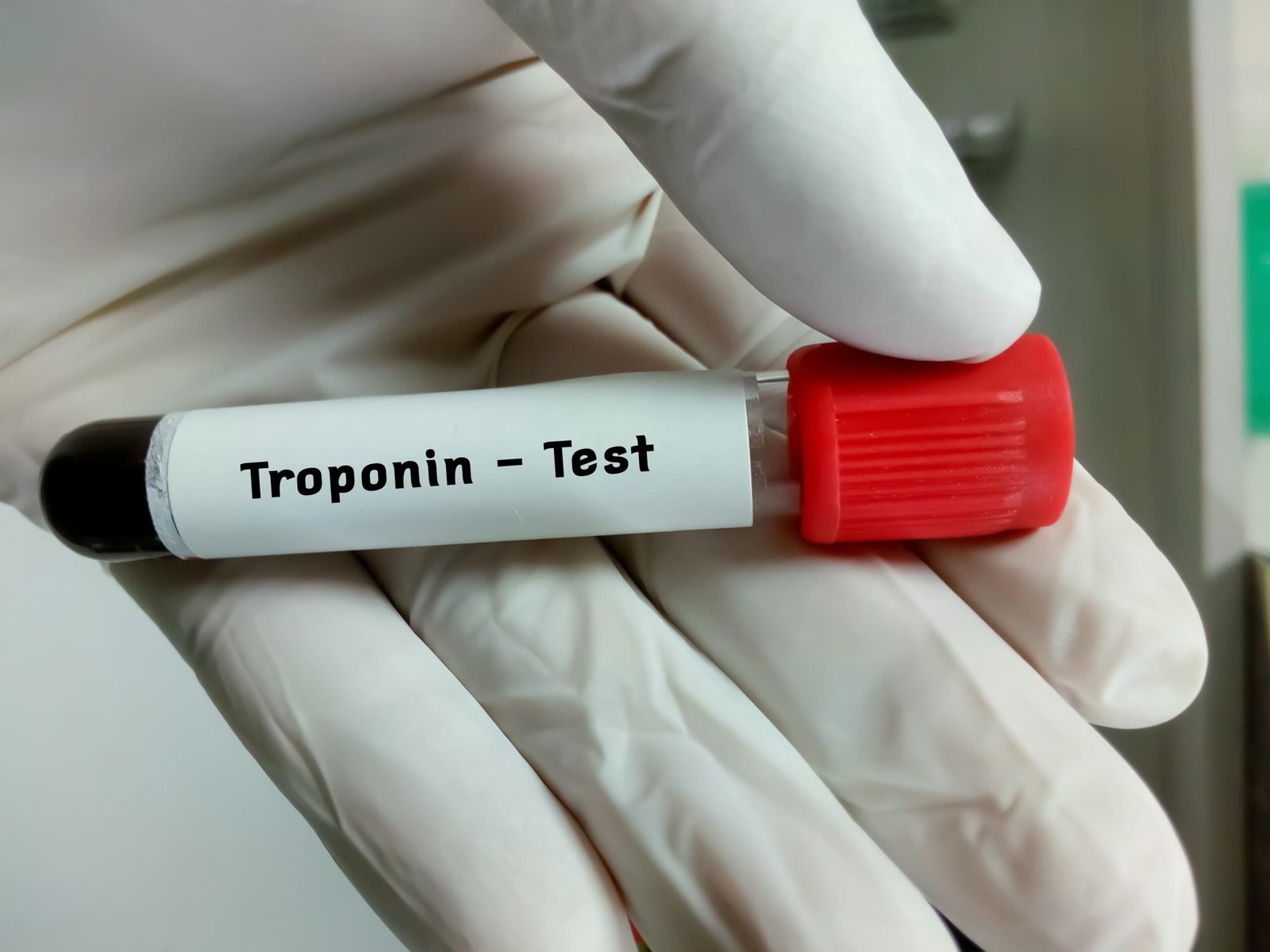 Troponin Test: What It Is, Normal Range & What Results Mean