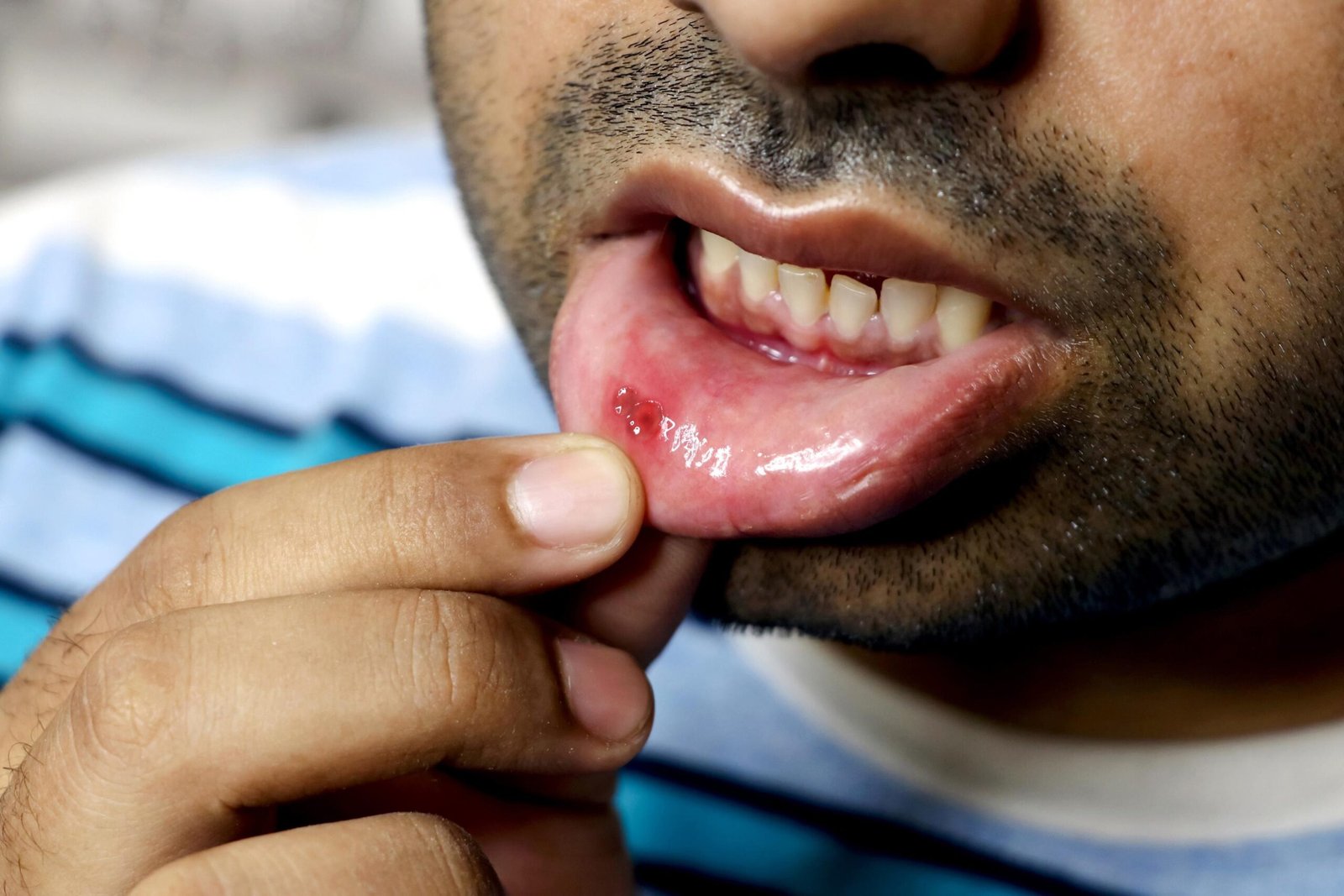 Mouth Ulcers: Why They Happen & How to Treat Them Fast